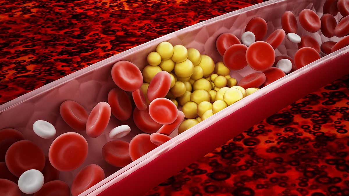 what-are-the-home-remedies-to-lower-triglycerides-in-the-blood?