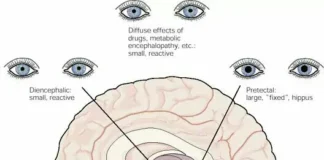 How to Evaluate the Pupillary Response in Traumatic Brain Injury?