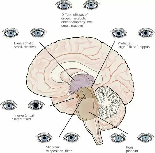 How to Evaluate the Pupillary Response in Traumatic Brain Injury?