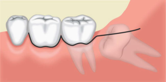 Techniques Used to Reposition Displaced Teeth